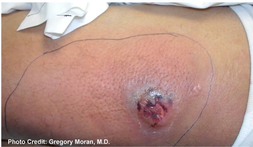 MRSA injury, open wound