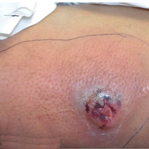 MRSA injury, open wound